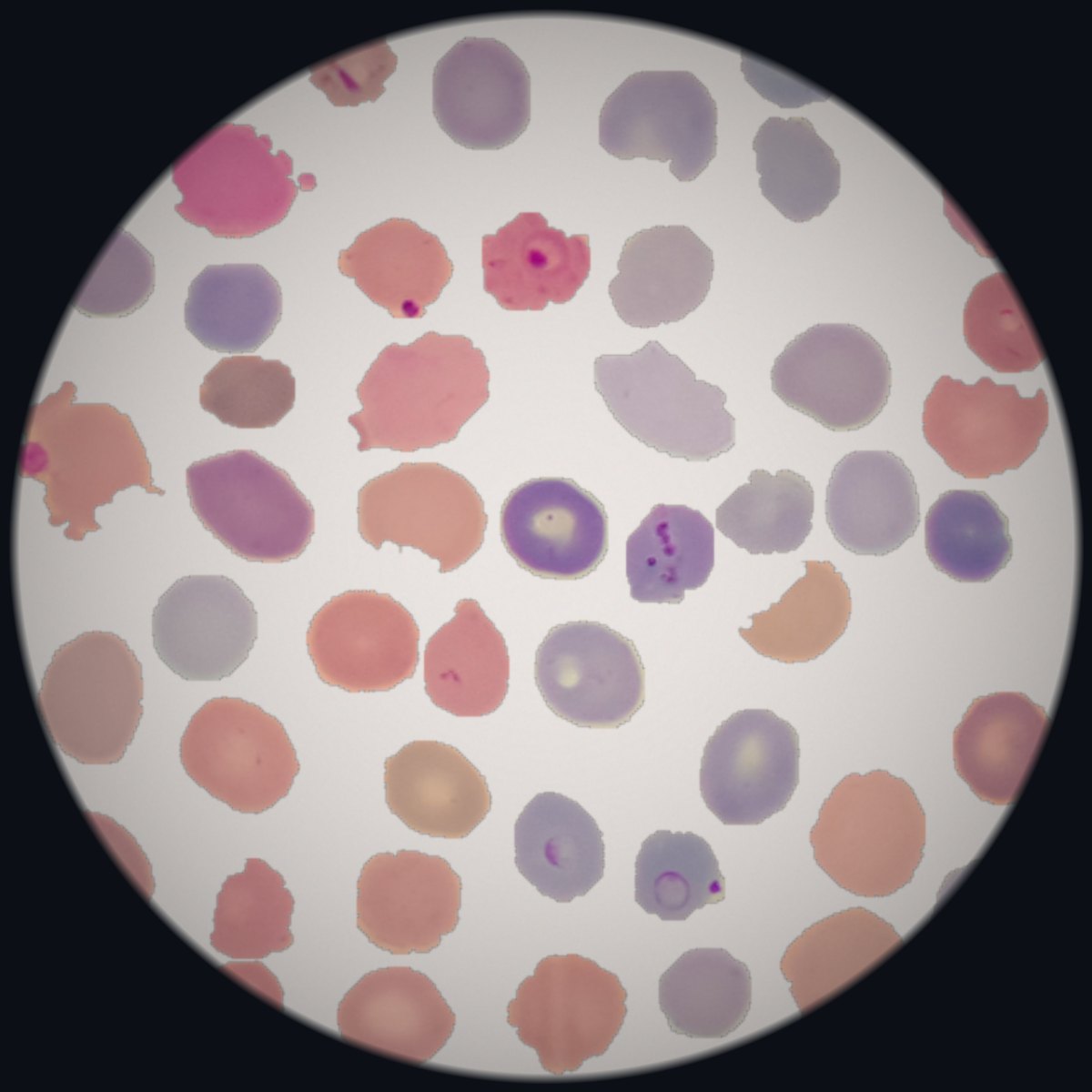 Giemsa-stained thin blood film seen through Ocular AI, with cells flagged by the malaria screening model